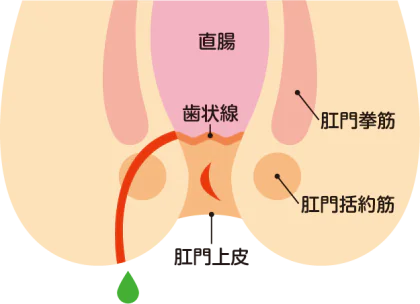 痔ろうの図