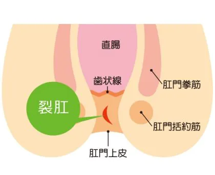 切れ痔（裂孔）