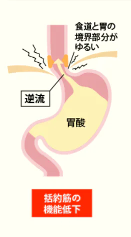 ①食道ー胃接合部の圧力の低下