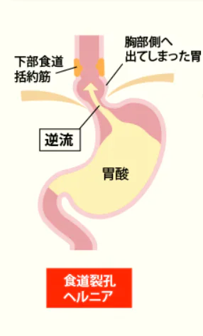 ②食道裂孔ヘルニア