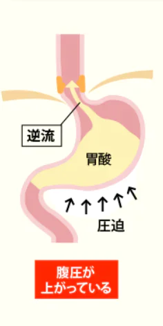 ③胃内容の停留、腹圧の上昇